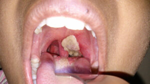 What you should know about Diphtheria