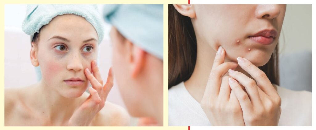 Best way to pop pimples, according to dermatologists