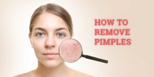 Simple ways to avoid acne