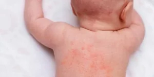 What every student needs to know about Stevens-Johnson syndrome